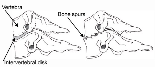 Cervical Disc Herniation | Symptoms and Treatment