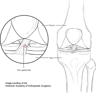 Knee Ligament Sprains And Tears | Genesis Orthopedics