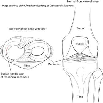 Meniscus Tears | Genesis Orthopedics & Sports Medicine