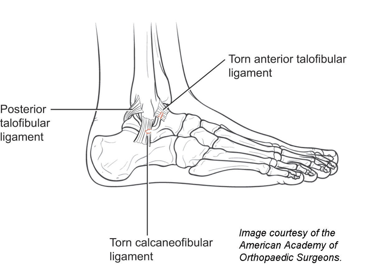 Foot and Ankle Muscle Strain | Genesis Orthopedics & Sports Medicine