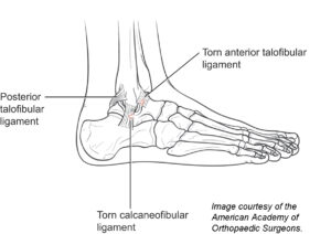 Understanding and Overcoming Pulled Muscle in Foot: A Comprehensive Guide
