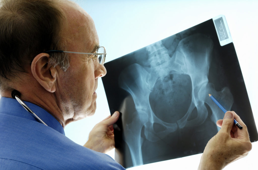 Doctor Looking at Hip X-ray