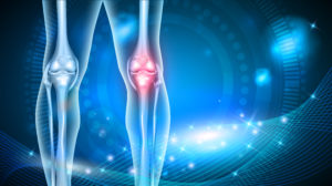 Knee Replacement 5