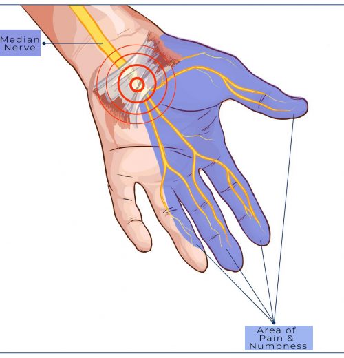 transverse carpal ligament compressed median nerve hand